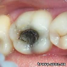 Пришеечный глубокий кариес зубов лечение