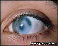 Лечение глаукомы